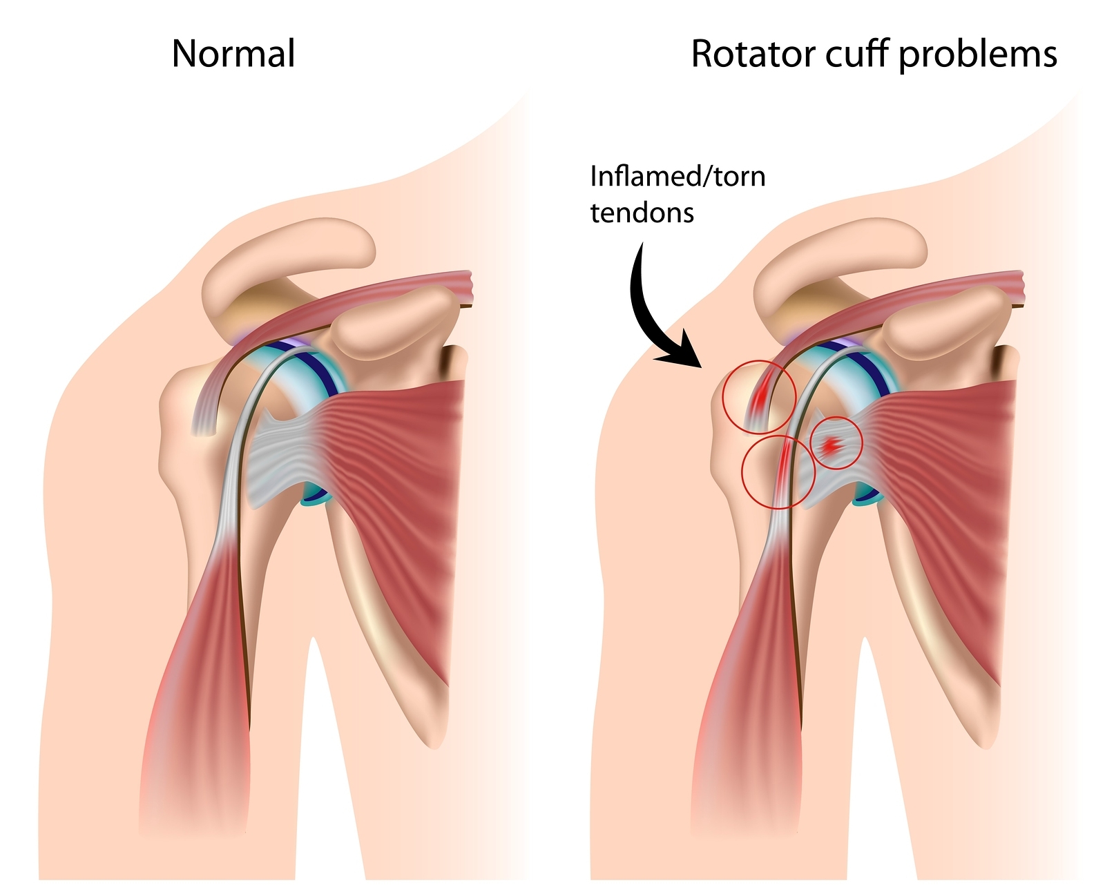 How to Rehabilitate Your Shoulder in 30 Days Without Cortisone Injections – Part II