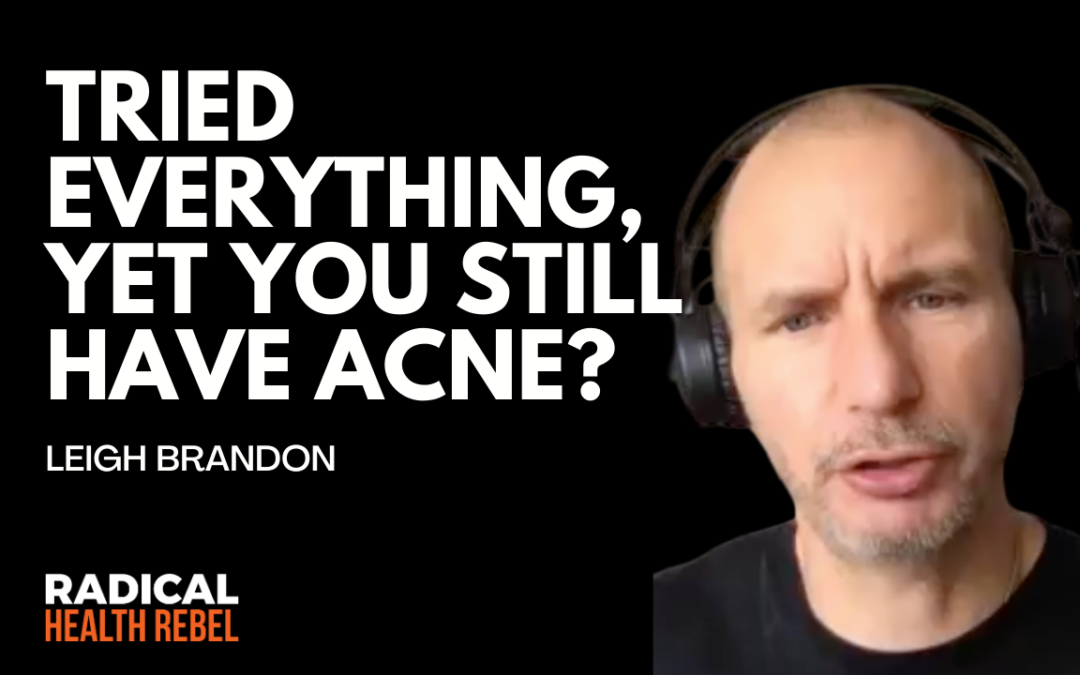 Tried Everything, Yet You Still Have Acne with Leigh Brandon